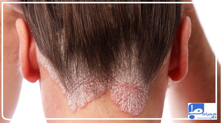 بیماری پسوریازیس چیست؟ | قاتل پسوریازیس، علائم
