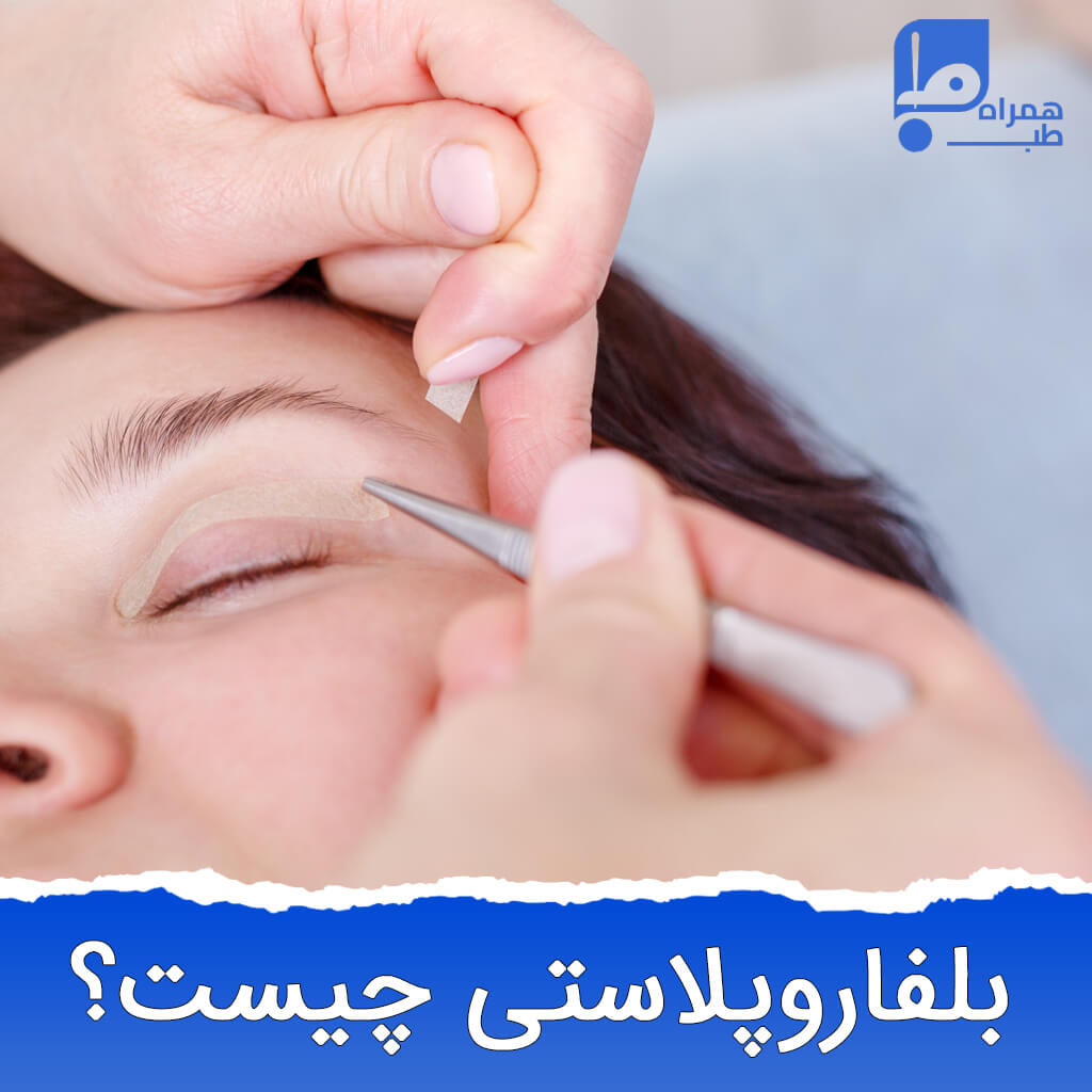 بلفاروپلاستی 