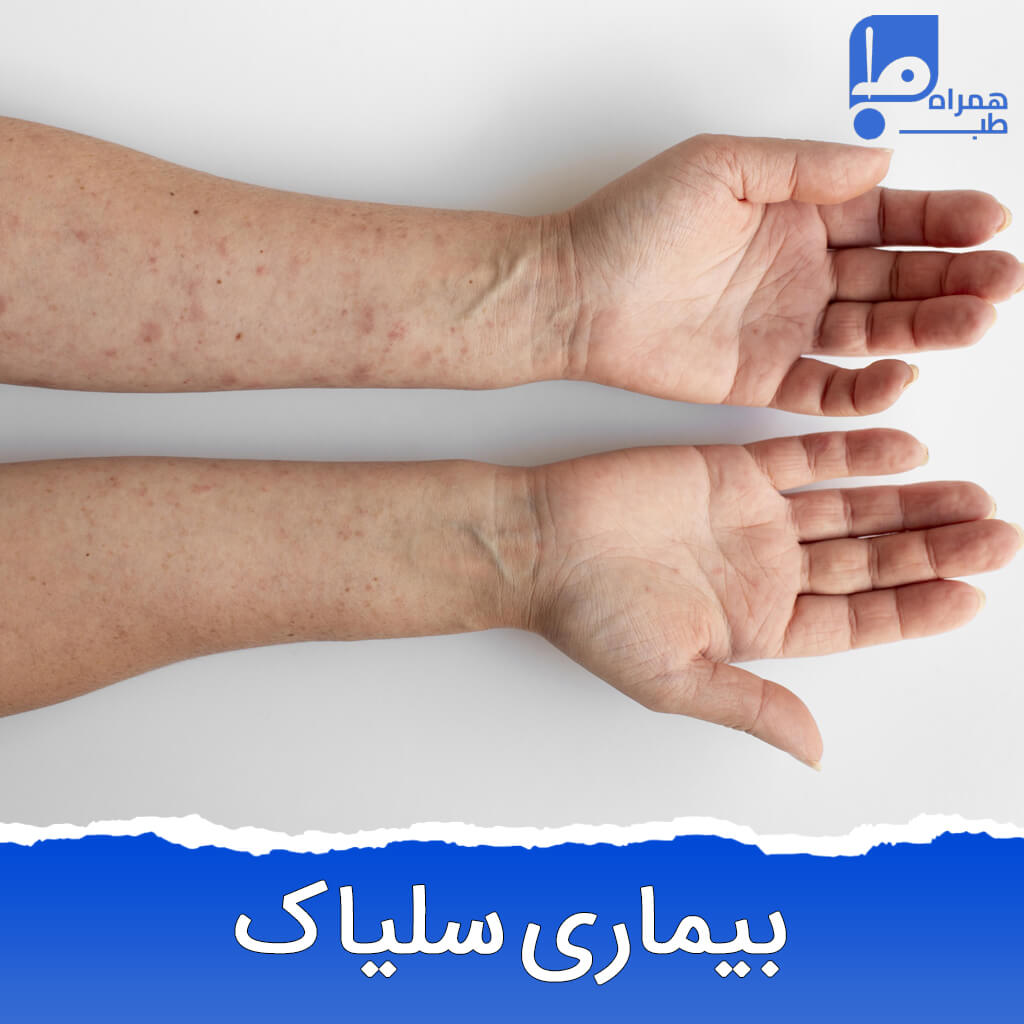 بیماری سلیاک