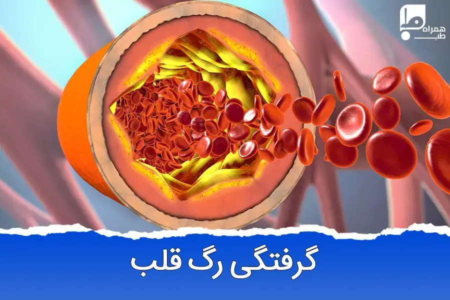 علائم و درمان گرفتگی رگ قلب: روش‌های طبیعی و پزشکی