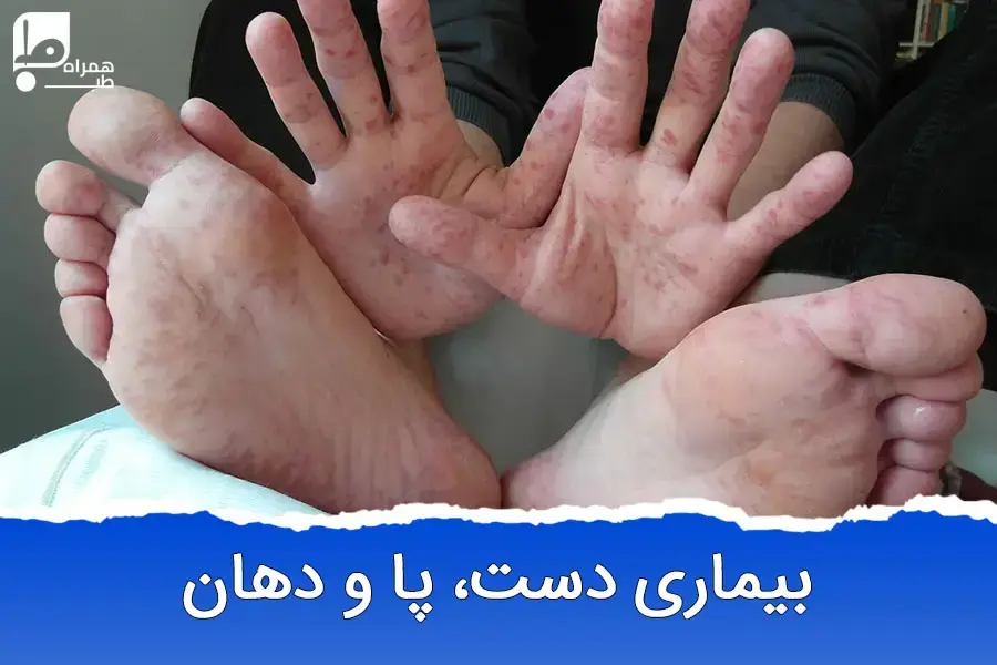 چگونه با بیماری دست، پا و دهان مقابله کنیم؟