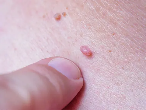 چگونه میتوان فهمید زگیل تناسلی داریم